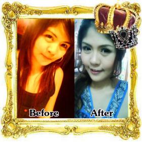 @ น้องปิง @ ก่อนใช้มีปัญหาผิวหน้าหมองคล้ำ ถุงใต้ตาบวมใหญ่