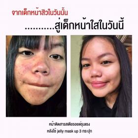 Jellymaskup ครีมออแกนิค รักษาสิว