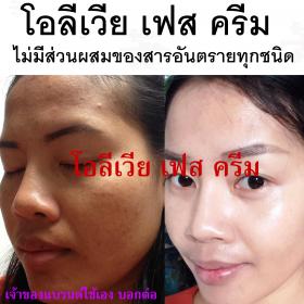 สิว รอยดำ รอยแดง ผิวคล้ำเสียสะสม ฝ้า กระ จุดด่างดำ